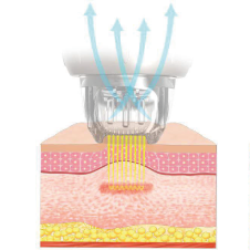 Zwolnienie próżni i igły
